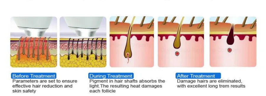 Professional 808nm Diode Laser Hair Removal Machine 3 wave Ice Titanium Painles Permanent Alexandrite Device For Salon Depilador