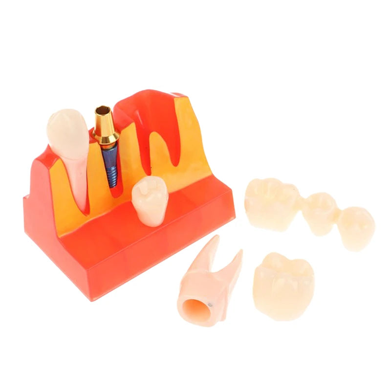 Dental 4 Times Implant Teeth Model Analysis Crown Bridge Demonstration Removable Model Dentistry Study Training Teaching Model
