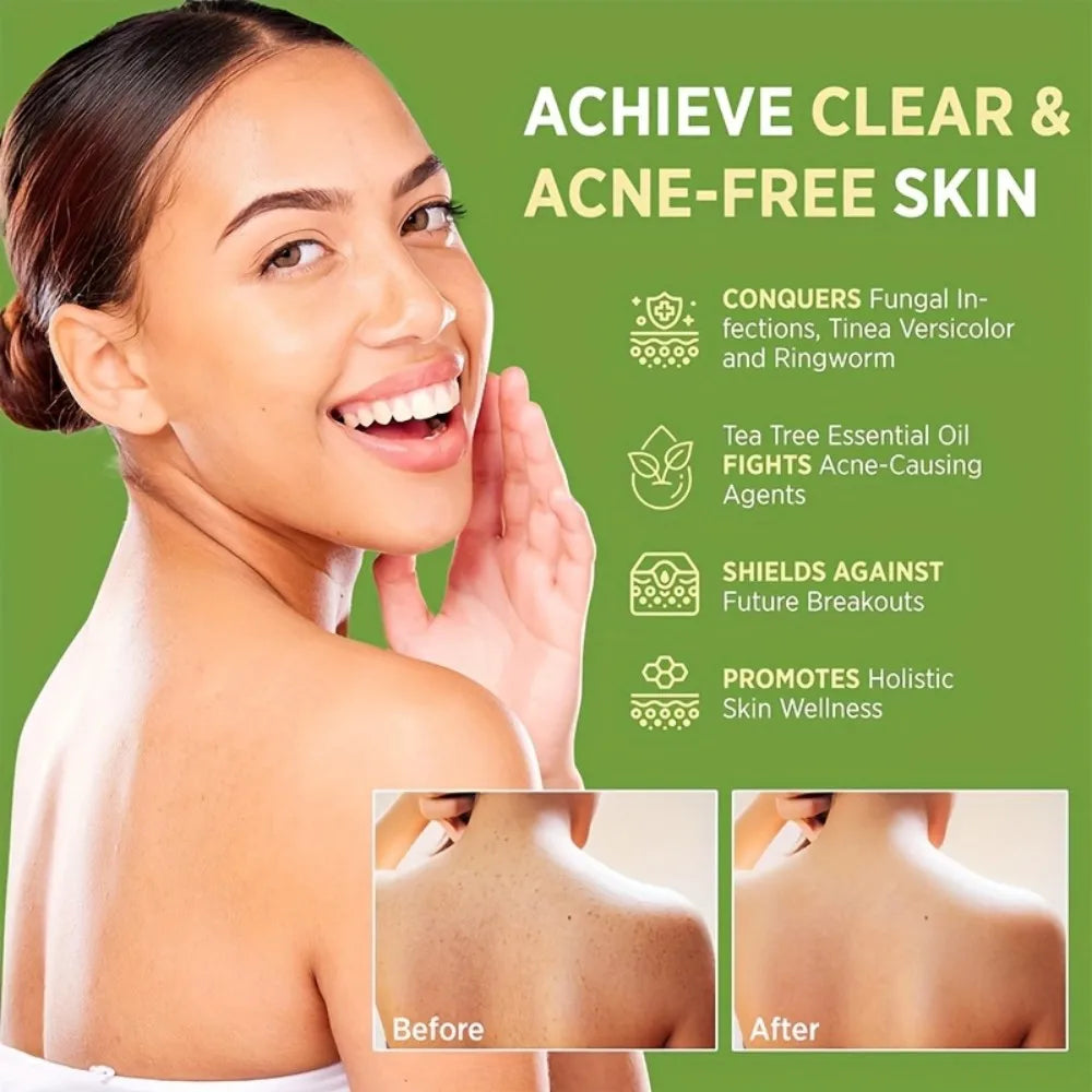 MIAOFUTONG Gentle for Sensitive Skin TEA TREE OIL ANTI-FUNGAL SOAP Plant-Based Care Moisturizing Formula Improving Acne