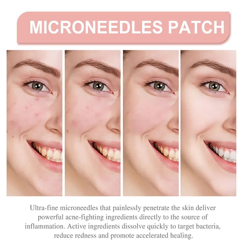 【Hot sales】72pcs Patches The Look Of Comedo And Invisible Concealer Breathable Covering Patch