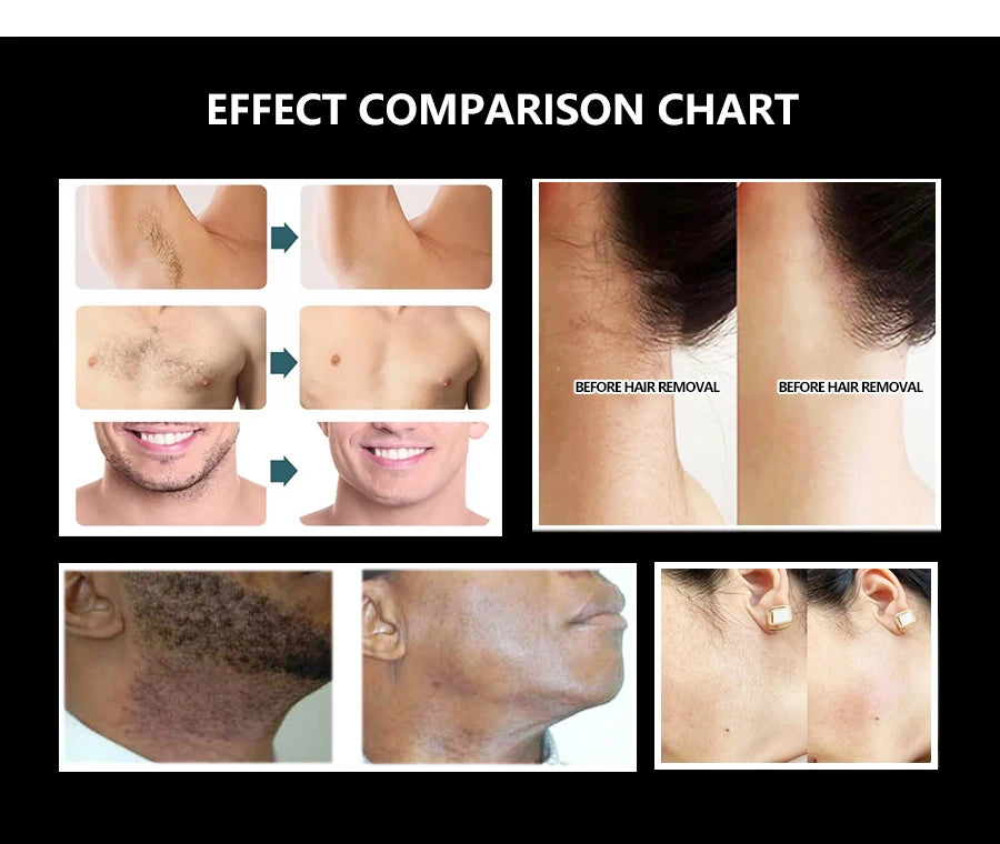 808 Diode Laser Hair Removal Machine 2025 3Wave Painless Permanent Portable 3000w Alma Soprano Titanium