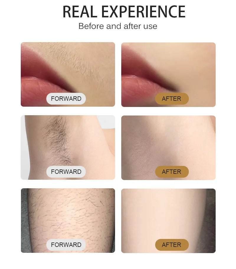 Diode Laser Hair Removal Equipment Freezing Point Painless And Safe Hair Removal System 3 Wavelength 755nm 808nm 1064nm HOT