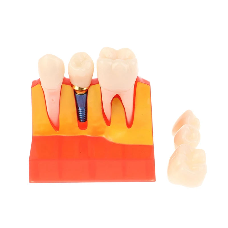 Dental 4 Times Implant Teeth Model Analysis Crown Bridge Demonstration Removable Model Dentistry Study Training Teaching Model