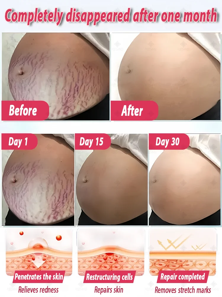 Choose the right product to make stretch marks invisible!