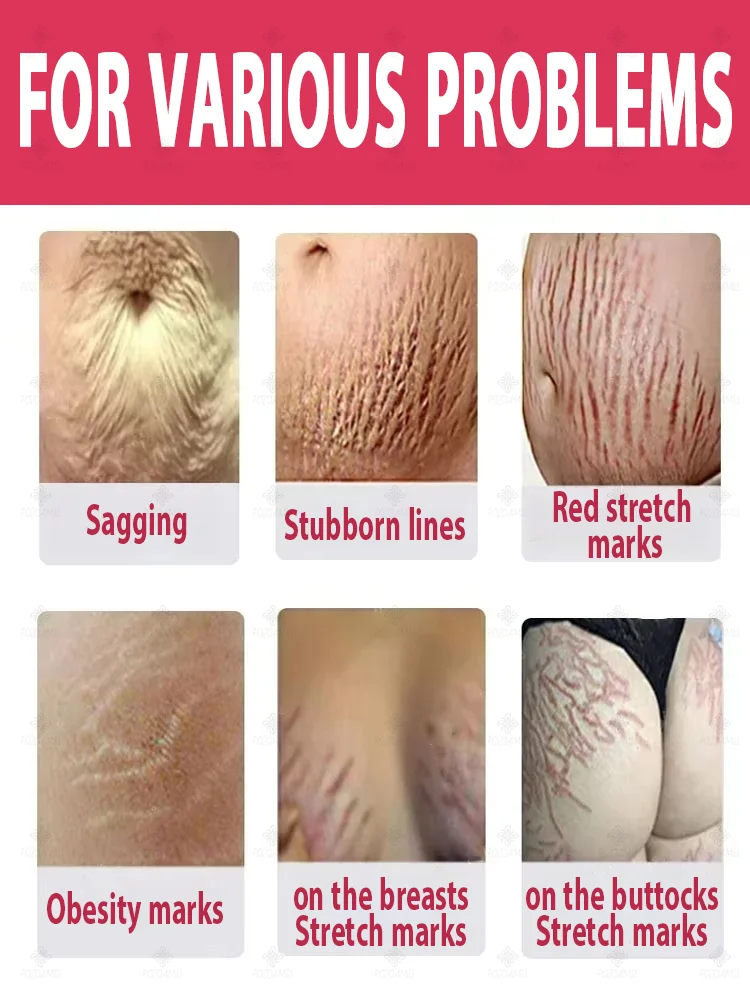 Choose the right product to make stretch marks invisible!