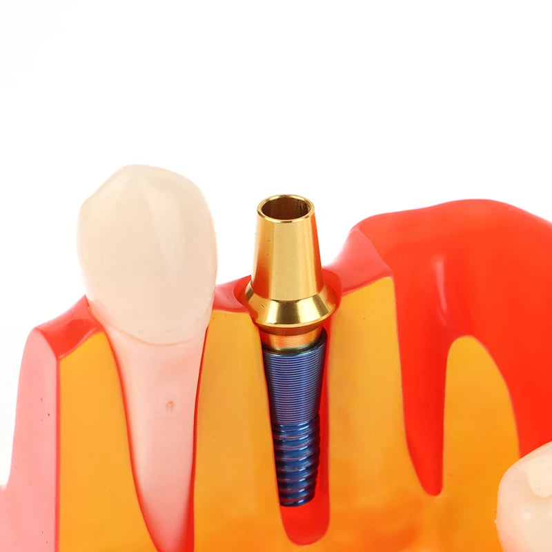 Dental 4 Times Implant Teeth Model Analysis Crown Bridge Demonstration Removable Model Dentistry Study Training Teaching Model