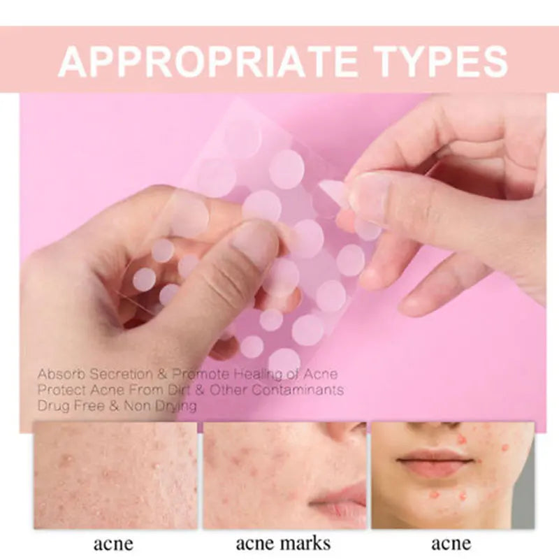【Hot sales】72pcs Patches The Look Of Comedo And Invisible Concealer Breathable Covering Patch