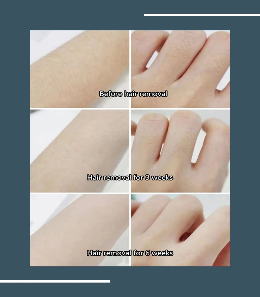808 Diode Laser Hair Removal Machine 2025 3Wave Painless Permanent Portable 3000w Alma Soprano Titanium