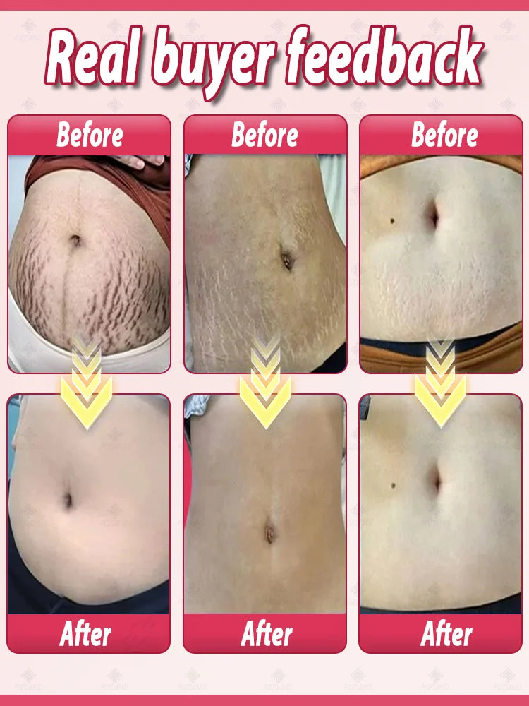 Choose the right product to make stretch marks invisible!