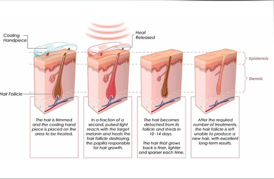 808 Diode Laser Hair Removal Machine 2025 3Wave Painless Permanent Portable 3000w Alma Soprano Titanium