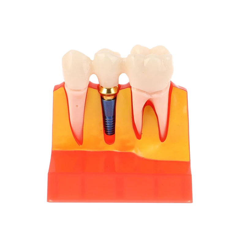 Dental 4 Times Implant Teeth Model Analysis Crown Bridge Demonstration Removable Model Dentistry Study Training Teaching Model