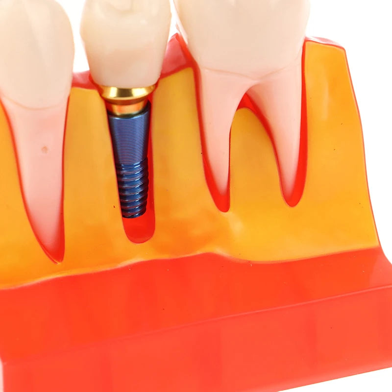 Dental 4 Times Implant Teeth Model Analysis Crown Bridge Demonstration Removable Model Dentistry Study Training Teaching Model