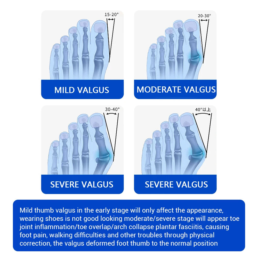 Bunion Adjuster Knob Adjustable Foot Hallux Valgus Braces Toe Straightener Pedicure Finger Toe Adjuster Unisex