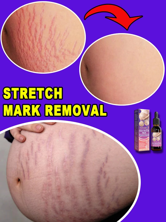 Choose the right product to make stretch marks invisible!