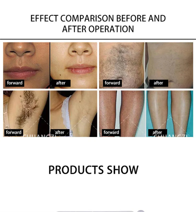 Newest 2000W 808nm diode l-aser 3 Wavelength 755 808 1064nm Hair Removal Machine Cooling Head Painless Epilator Face Body